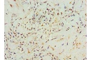 Immunohistochemistry of paraffin-embedded human breast cancer using ABIN7144316 at dilution of 1:100 (AGR2 antibody  (AA 21-175))