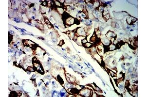 Immunohistochemical analysis of paraffin-embedded breast cancer tissues using KRT13 mouse mAb with DAB staining.