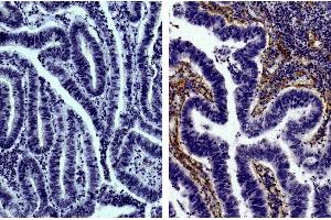 Paraffin embedded human gastric cancer tissue was stained with Goat IgG-UNLB isotype control, DAB, and hematoxylin. (Collagen IV antibody  (Biotin))