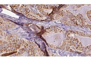 ABIN6267091 at 1/100 staining Human thyroid cancer tissue by IHC-P. (TBC1D4 antibody  (pSer318))
