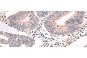 Immunohistochemistry of paraffin-embedded Human colorectal cancer tissue using GKAP1 Polyclonal Antibody at dilution of 1:95(x200) (GKAP1 antibody)