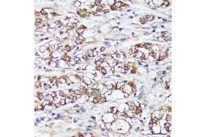 Immunohistochemistry of paraffin-embedded human liver cancer using MTHFD2 antibody (ABIN6132367, ABIN6144144, ABIN6144145 and ABIN6214625) at dilution of 1:100 (40x lens). (MTHFD2 antibody  (AA 40-250))