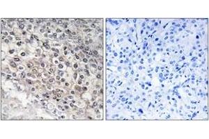 Immunohistochemistry analysis of paraffin-embedded human liver carcinoma tissue, using Cytochrome P450 2W1 Antibody. (CYP2W1 antibody  (AA 311-360))