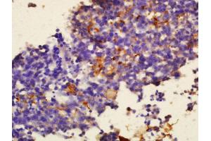 Formalin-fixed and paraffin embedded human glioma tissue labeled with Anti-Sialoadhesin Polyclonal Antibody, Unconjugated (ABIN2179210) at 1:300 followed by conjugation to the secondary antibody and DAB staining. (Sialoadhesin/CD169 antibody  (AA 851-950))