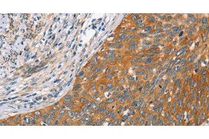 Immunohistochemistry of paraffin-embedded Human cervical cancer tissue using Crystallin-alpha C Polyclonal Antibody at dilution 1:45 (HSPB8 antibody)