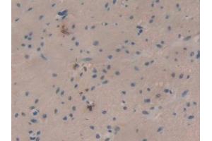 DAB staining on IHC-P; Samples: Human Colorectal cancer Tissue (SLURP1 antibody  (AA 1-103))