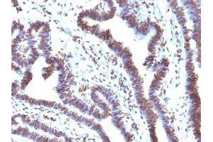 Formalin-fixed, paraffin-embedded human Ovarian Carcinoma stained with EMI1 Mouse Monoclonal Antibody (EMI1/1176). (FBXO5 antibody  (AA 1-250))