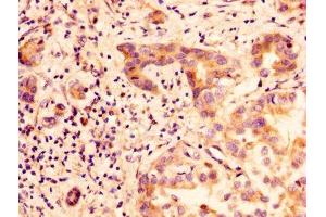 IHC image of ABIN7153857 diluted at 1:100 and staining in paraffin-embedded human liver cancer performed on a Leica BondTM system. (GLIPR1 antibody  (AA 22-232))