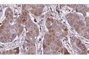ABIN6276641 at 1/100 staining Human liver cancer tissue by IHC-P. (F11R antibody  (C-Term))