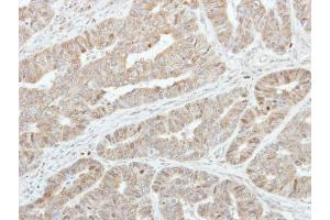 IHC-P Image Immunohistochemical analysis of paraffin-embedded human colon carcinoma, using GSTA1, antibody at 1:250 dilution. (GSTA1 antibody)