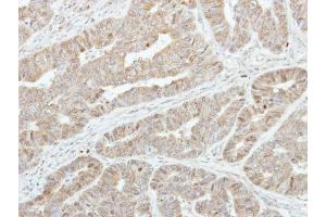 IHC-P Image Immunohistochemical analysis of paraffin-embedded human colon carcinoma, using GSTA1, antibody at 1:250 dilution.