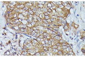 Immunohistochemistry of paraffin-embedded Human mammary cancer using CTTN Polyclonal Antibody at dilution of 1:100 (40x lens). (Cortactin antibody)