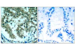 Immunohistochemical analysis of paraffin-embedded human lung carcinoma tissue, using PKCθ (Ab-676) antibody (E021289). (PKC theta antibody)
