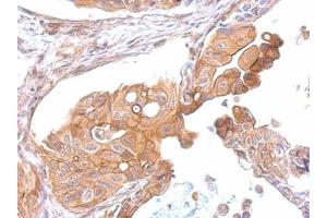 IHC-P Image CCR8 antibody detects CCR8 protein at membrane on human gastric cancer by immunohistochemical analysis. (CCR8 antibody  (C-Term))