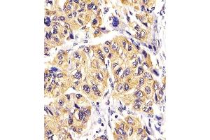Antibody staining PDGFRA in Human hepatic carcinoma tissue sections by Immunohistochemistry (IHC-P - paraformaldehyde-fixed, paraffin-embedded sections). (PDGFRA antibody  (AA 698-727))