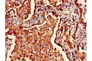 Immunohistochemistry of paraffin-embedded human lung cancer using ABIN7155618 at dilution of 1:100 (HLA-DRB1 antibody  (AA 31-266) (Biotin))