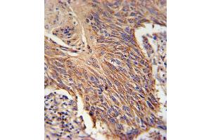 RDH10 Antibody (Center) (ABIN650935 and ABIN2840001) immunohistochemistry analysis in formalin fixed and paraffin embedded lung carcinoma followed by peroxidase conjugation of the secondary antibody and DAB staining. (RDH10 antibody  (AA 106-135))