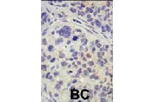 Formalin-fixed and paraffin-embedded human cancer tissue reacted with USP8 polyclonal antibody  , which was peroxidase-conjugated to the secondary antibody, followed by AEC staining . (USP8 antibody  (C-Term))