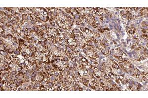 ABIN6279676 at 1/100 staining Human liver cancer tissue by IHC-P.