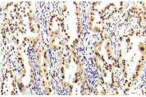 Immunohistochemistry (IHC) analyzes of STAT-5A antibody in paraffin-embedded human lung carcinoma tissue. (STAT5A antibody)