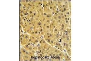 FBP1 Antibody (N-term) (ABIN391576 and ABIN2841511) IHC analysis in formalin fixed and paraffin embedded human hepatocarcinoma followed by peroxidase conjugation of the secondary antibody and DAB staining. (FBP1 antibody  (N-Term))