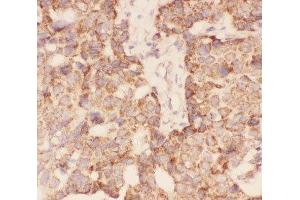 IHC-P: FSH beta antibody testing of human breast cancer tissue (FSHB antibody  (AA 19-129))