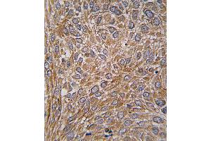 Formalin-fixed and paraffin-embedded human lung carcinoma tissue reacted with GIT1 Antibody (Y510) , which was peroxidase-conjugated to the secondary antibody, followed by DAB staining. (GIT1 antibody  (AA 487-517))