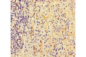 Immunohistochemistry of paraffin-embedded human lung cancer using ABIN7145044 at dilution of 1:100 (ATAD3C antibody  (AA 1-122))