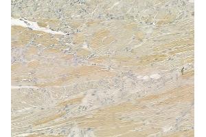 ABIN6260121 and ABIN6276509 at 1/100 staining human tongue carcinoma by IHC-P.