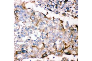 Anti- GFRA1 antibody, IHC(P) IHC(P): Human Lung Cancer Tissue (GFRA1 antibody  (AA 25-227))