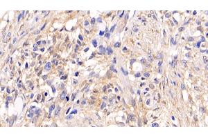 Detection of ERK1 in Human Ovarian cancer Tissue using Monoclonal Antibody to Extracellular Signal Regulated Kinase 1 (ERK1) (ERK1 antibody  (AA 75-312))