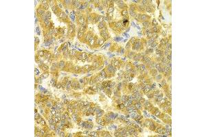 Immunohistochemistry of paraffin-embedded human thyroid cancer using DLD Antibody. (DLD antibody  (AA 36-300))