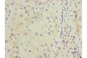 Immunohistochemistry of paraffin-embedded human liver cancer using ABIN7174715 at dilution of 1:100 (C11orf53 antibody  (AA 13-236))