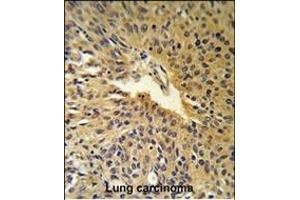COG2 Antibody (N-term) (R) IHC analysis in formalin fixed and paraffin embedded human Lung carcinoma followed by peroxidase conjugation of the secondary antibody and DAB staining. (COG2 antibody  (N-Term))