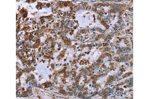 Immunohistochemistry of Human liver cancer using IMPDH2 Polyclonal Antibody at dilution of 1:60 (IMPDH2 antibody)
