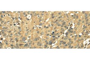 Immunohistochemistry of paraffin-embedded Human breast cancer using RPS3 Polyclonal Antibody at dilution of 1/25 (RPS3 antibody)