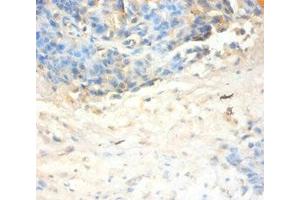 Immunohistochemistry of paraffin-embedded human ovarian cancer using ABIN7144333 at dilution of 1:100 (SLPI antibody  (AA 26-132))