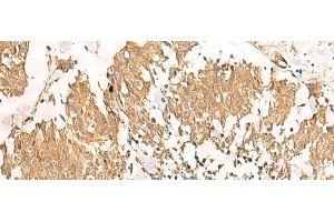 Immunohistochemistry of paraffin-embedded Human lung cancer tissue using MTHFD2L Polyclonal Antibody at dilution of 1:30(x200) (MTHFD2L antibody)