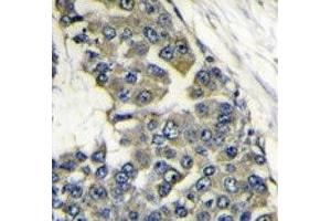 IHC analysis of FFPE human breast carcinoma stained with EIF4B antibody (EIF4B antibody  (AA 353-382))