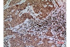 Immunohistochemistry (IHC) analysis of paraffin-embedded Human Mammary Cancer, antibody was diluted at 1:100. (CACYBP antibody  (C-Term))