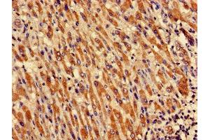 Immunohistochemistry of paraffin-embedded human liver cancer using ABIN7149048 at dilution of 1:100 (CRIPT antibody  (AA 1-101))