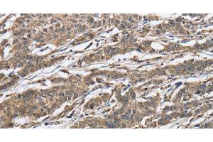 Immunohistochemistry of paraffin-embedded Human gastic cancer using IPO7 Polyclonal Antibody at dilution of 1:40 (IPO7 antibody)