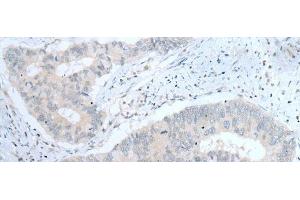 Immunohistochemistry of paraffin-embedded Human colorectal cancer tissue using ITGA8 Polyclonal Antibody at dilution of 1:30(x200) (ITGA8 antibody)