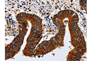 The image on the left is immunohistochemistry of paraffin-embedded Human colon cancer tissue using ABIN7130042(KRT23 Antibody) at dilution 1/20, on the right is treated with fusion protein. (KRT23 antibody)