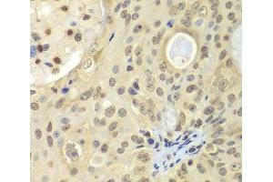 Immunohistochemistry of paraffin-embedded Human oophoroma using ULK4 Polyclonal Antibody at dilution of 1:100 (40x lens).