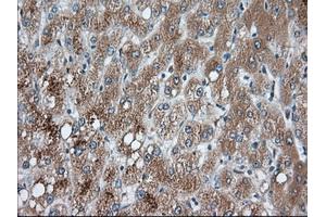 Immunohistochemical staining of paraffin-embedded Carcinoma of Human prostate tissue using anti-PANK2 mouse monoclonal antibody.