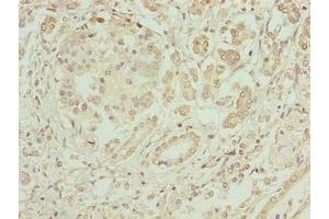 Immunohistochemistry of paraffin-embedded human pancreatic cancer using ABIN7152004 at dilution of 1:100 (ERO1LB antibody  (AA 101-400))