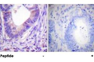 Immunohistochemical analysis of paraffin-embedded human colon carcinoma tissue using PRKACA polyclonal antibody . (PRKACA antibody)