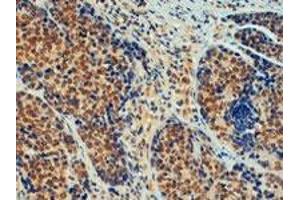 TRIM24 polyclonal antibody  (4 ug/mL) staining of paraffin embedded human breast cancer.