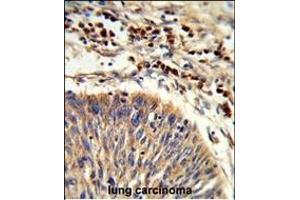 Formalin-fixed and paraffin-embedded human lung carcinoma reacted with HS Antibody (C-term), which was peroxidase-conjugated to the secondary antibody, followed by DAB staining. (HSPA6 antibody  (C-Term))